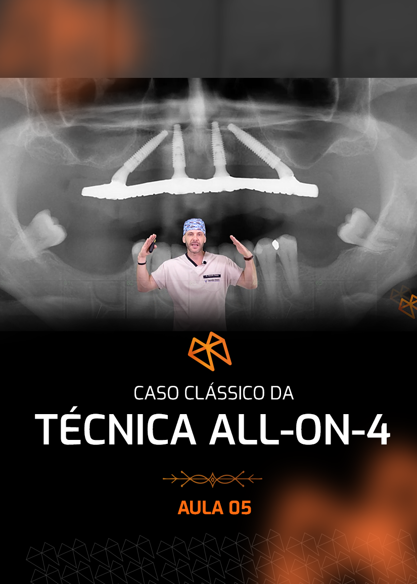 FPM 05 - CASO CLÁSSICO DA TÉCNICA ALL-ON-4