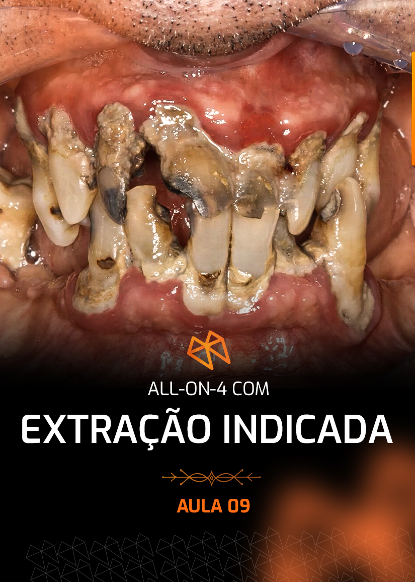 FPM 09 - ALL-ON-4 COM EXTRAÇÃO INDICADA