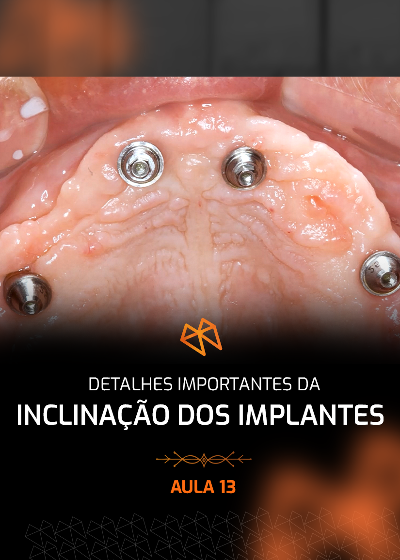 FPM 13 - DETALHES IMPORTANTES DA INCLINAÇÃO DOS IMPLANTES